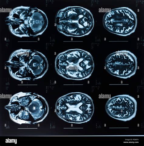 the villages brain scan mri|MRI SCANS .